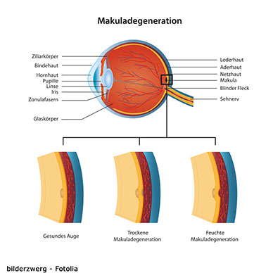 Dr. Hoppelshäuser Augenarzt Nittendorf Makuladegeneration